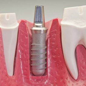Incamol implante de dientes